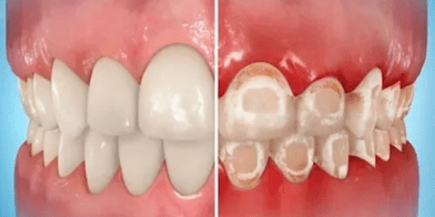 警惕 牙齿上出现白色斑点是什么情况