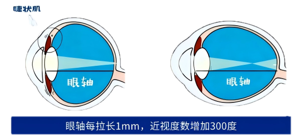 12.15眼轴拉长(1).png 12.15眼轴拉长(1).png