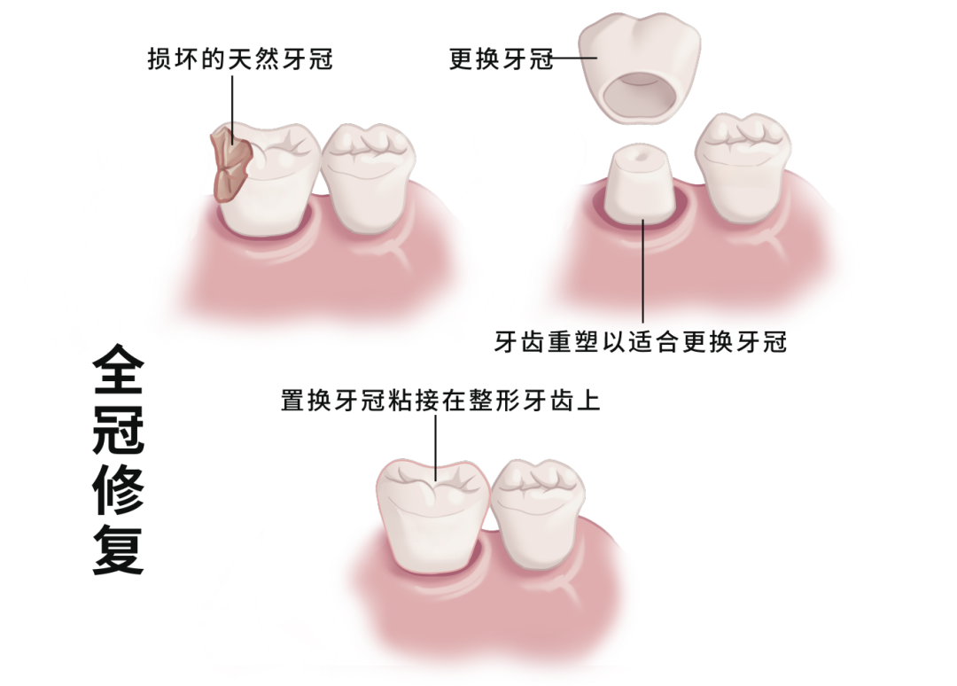 牙冠修复 4.6.png 牙冠修复 4.6.png